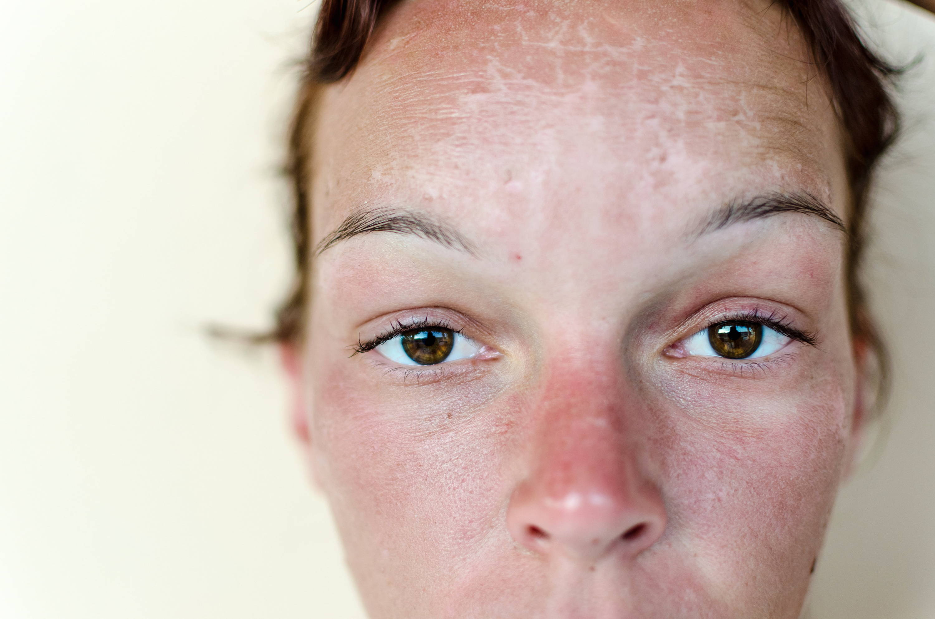 What tanning does to your acne, according to dermatologists